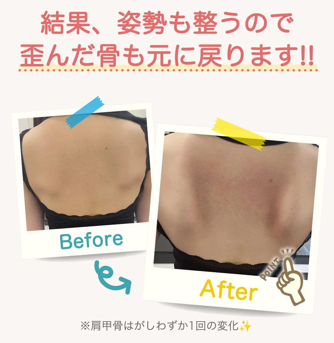 結果、姿勢も整うので歪んだ骨も元に戻ります！肩甲骨のビフォーアフター※肩甲骨はがしわずか1回の変化